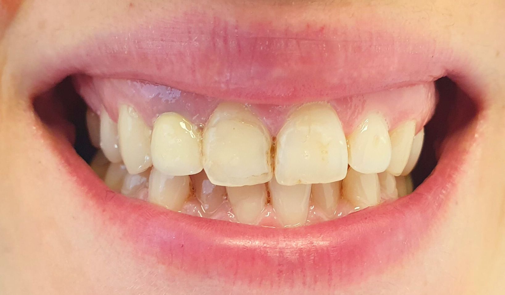 Composite Bonding Dental Art Implant Clinics